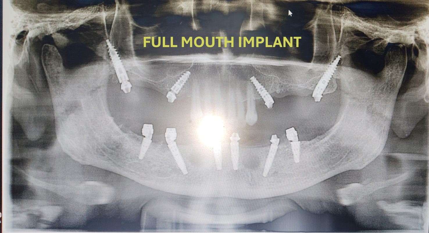 Implant X-Ray