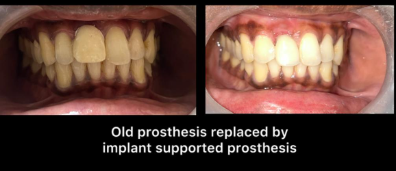Transforming Smiles: A Journey from Temporary to Permanent Implant Restoration